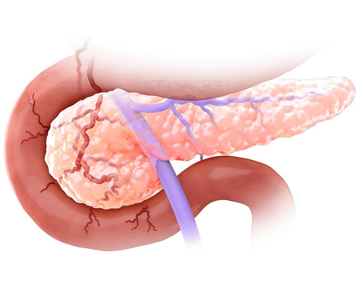 Scientific illustration of the pancreas, one of the organs TriSalus focuses on.