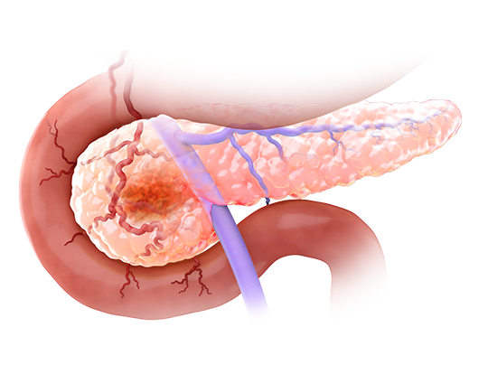 Scientific illustration of a pancreas with a pancreatic ductal adenocarcinoma