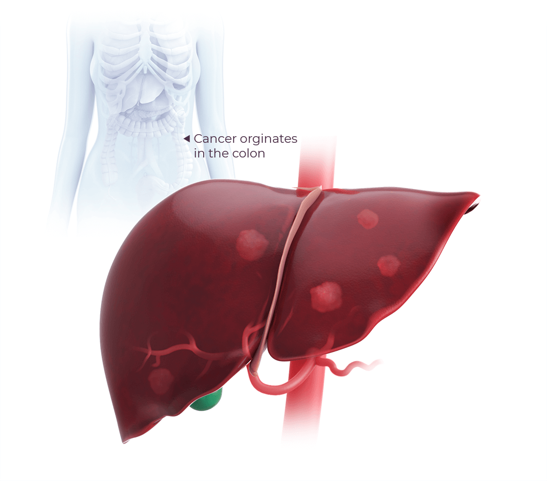 colorectal-cancer-with-liver-metastases-treatment-approach