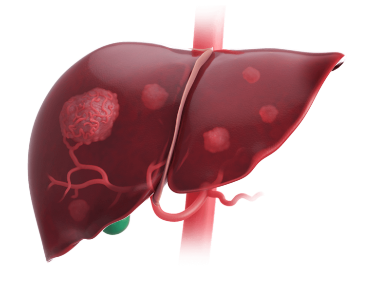 hepatocellular-carcinoma-hcc-treatment-approach