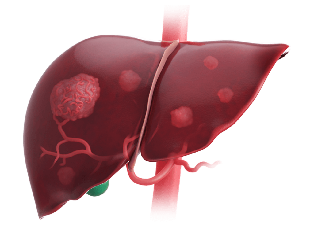 Scientific illustration of a liver with a primary intrahepatic cholangiocarcinoma and multiple metastases