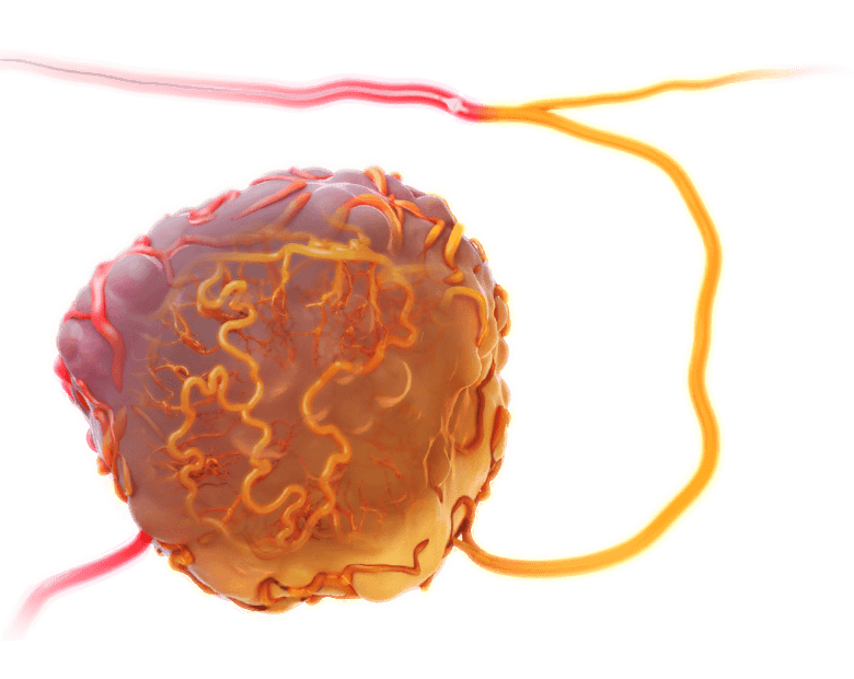 Scientific illustration of a drug delivery device approaching a tumor via the blood vessels and delivering therapy which perfuses throughout the tumor.