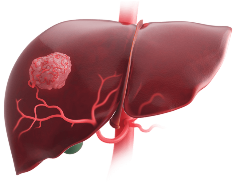 Scientific illustration of a tumor in the liver and a small drug delivery device approaching the tumor via the main blood vessels supplying the liver.