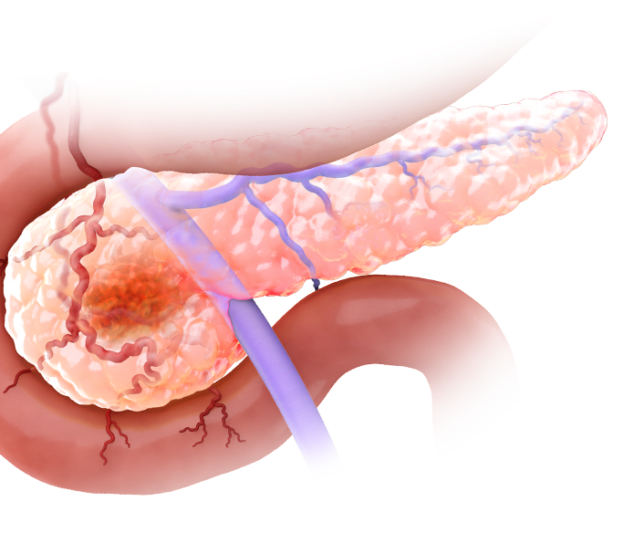 Scientific illustration of a tumor in the pancreas and a small delivery device approaching the tumor via the venous system