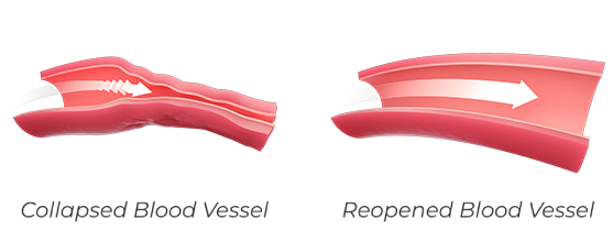 Scientific illustration of a collapsed blood vessel restricting blood flow, and restoration of blood flow after the vessel is reopened.