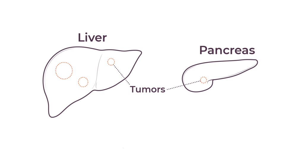 Illustration of the liver and the pancreas, two organs in which a dysfunctional immune system plays a role in tumor progression.