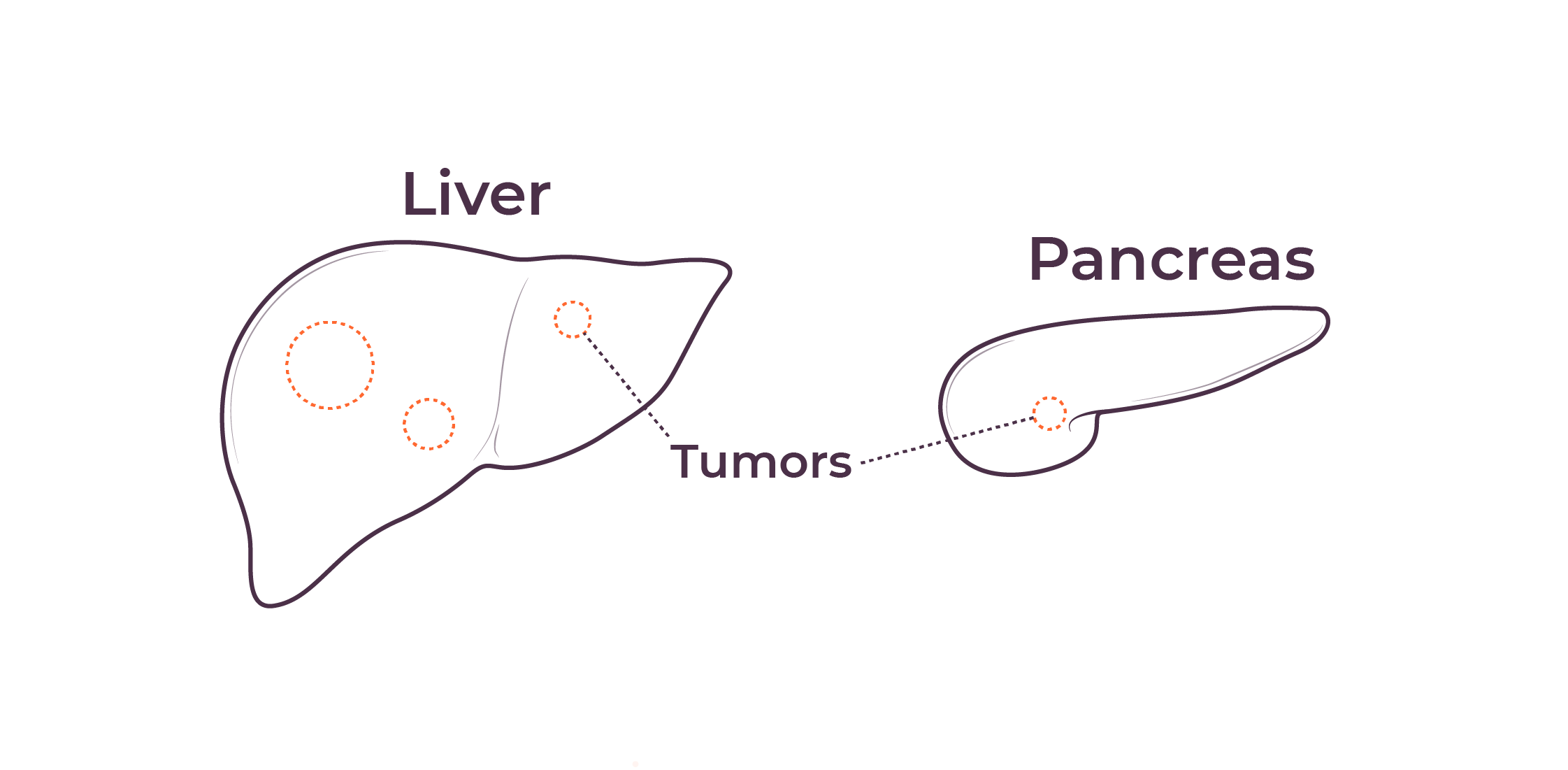 Illustration of the liver and the pancreas, two organs in which a dysfunctional immune system plays a role in tumor progression.