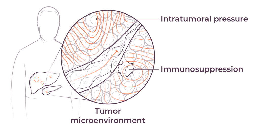 Illustration of the location of the liver and pancreas in an elderly man, with a callout bubble to show the tumor microenvironment, including immunosuppression and intratumoral pressure.