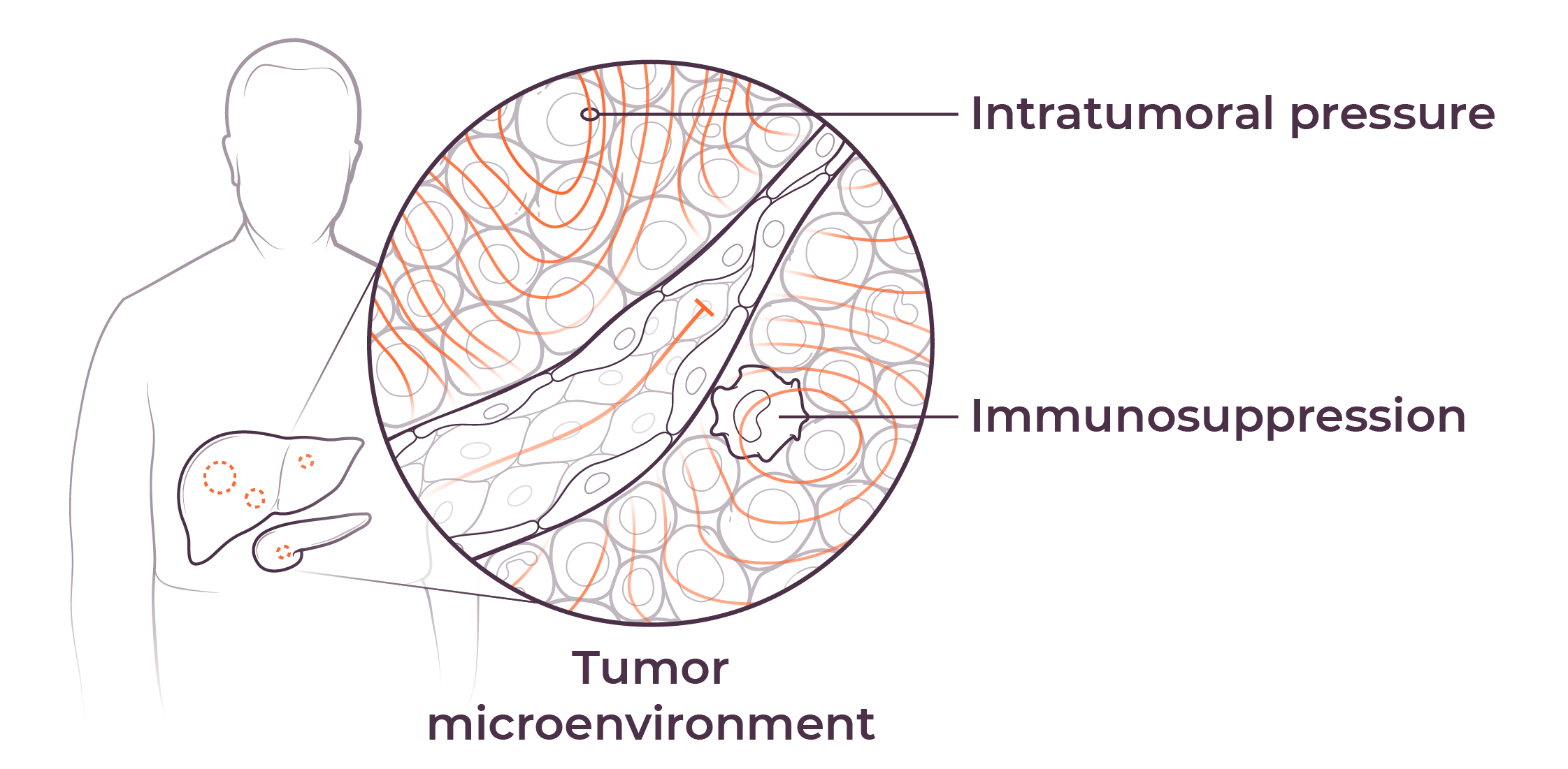 Illustration of the location of the liver and pancreas in an elderly man, with a callout bubble to show the tumor microenvironment, including immunosuppression and intratumoral pressure.
