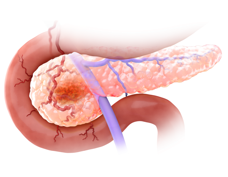 Scientific illustration of a tumor in the pancreas and a small delivery device approaching the tumor via the venous system.